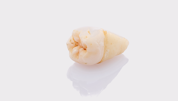 抜歯